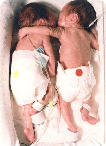 Эти близнецы, брат и сестра, родились раньше срока, и состо
